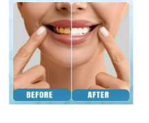 Cargar imagen en el visor de la galería, Kit de Blanqueamiento dental con Bolígrafo de Gel