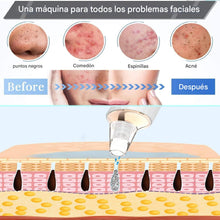 Cargar imagen en el visor de la galería, Aspirador de poros para eliminar puntos negros