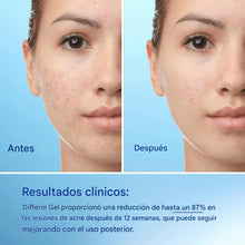 Cargar imagen en el visor de la galería, Differin Adapalene Gel 0.1% Tratamiento acné
