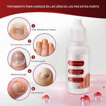 Cargar imagen en el visor de la galería, Tratamiento para Uñas de los Pies, Fungi Nail