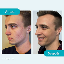 Cargar imagen en el visor de la galería, Tratamiento Proactiv para el acné en 3 pasos