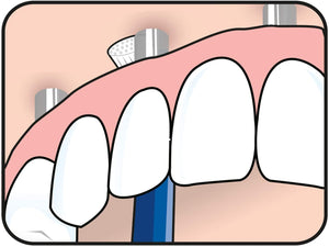 Tepe - Implantes Dentales NPD45